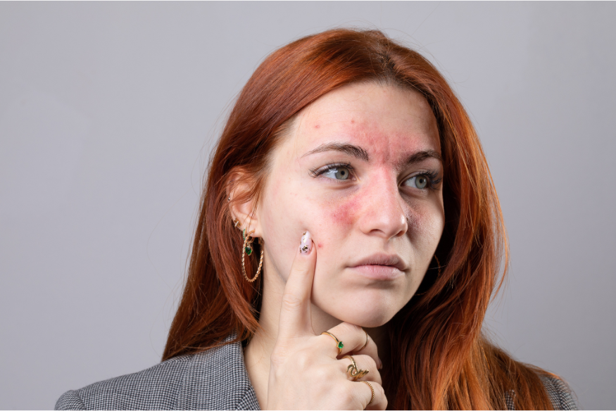 Rosacea / Skin Irritations
