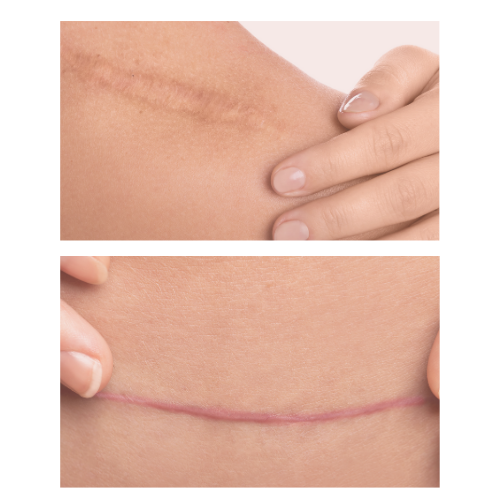Scar Release Therapy | WholeBody Energetics