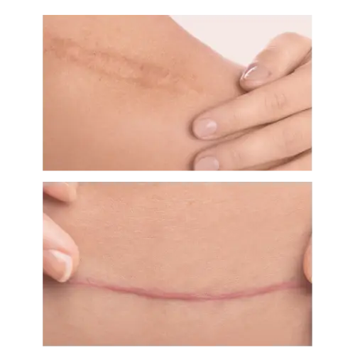 Scar Release Therapy | WholeBody Energetics